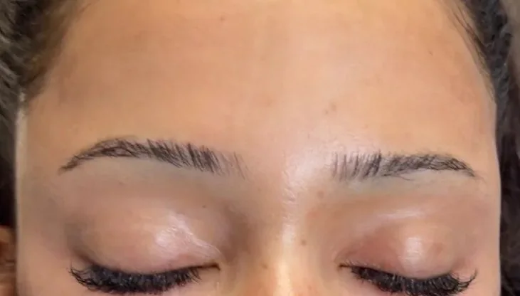 Under-eye and temple area after EZ Gel plasma bio-filler