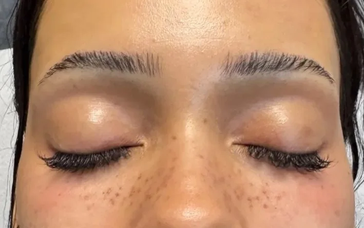 Under-eye area with eyes closed after EZ Gel plasma bio-filler