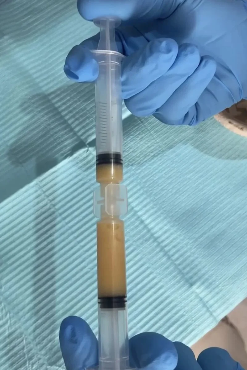 Gloved hands holding two syringes of golden plasma gel joined by a connector, used to blend the patient's own plasma into EZ Gel
