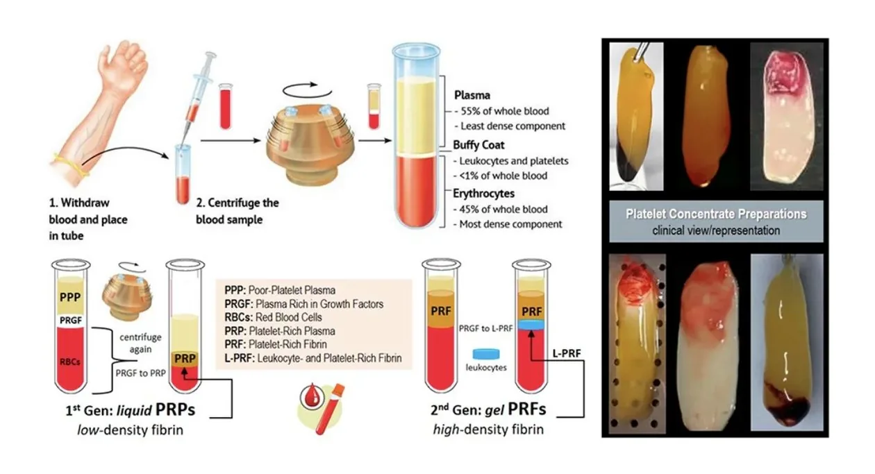 Diagram: blood is withdrawn and centrifuged into plasma, buffy coat and red blood cells, producing first-generation liquid PRP and second-generation gel PRF, with photographs of platelet concentrate preparations