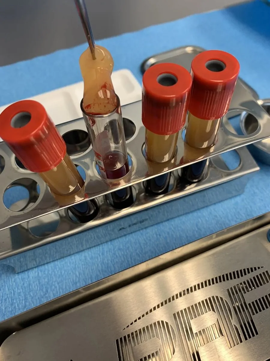 A PRF clot lifted on tweezers from a blood tube, beside further tubes of centrifuged blood in a steel rack