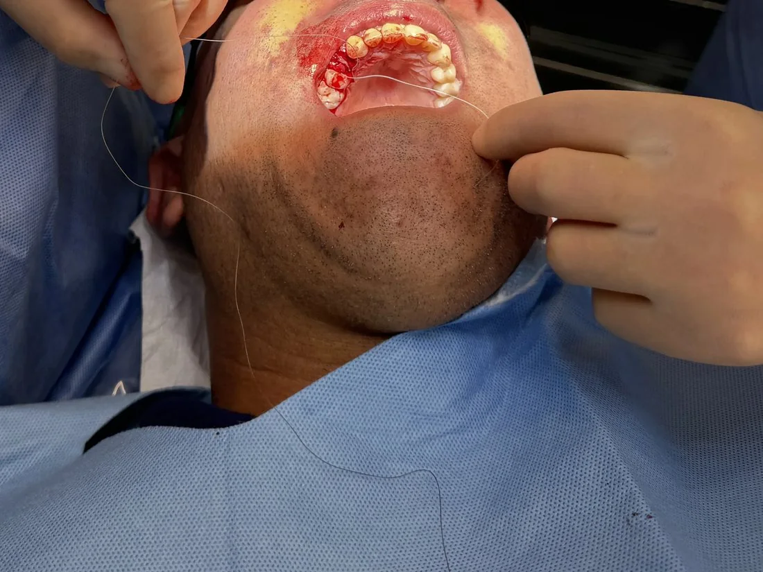Gloved hands closing an oral surgical site with sutures