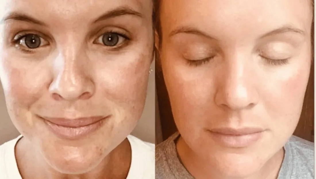 Side-by-side close-up photographs of a face, before and after treatment