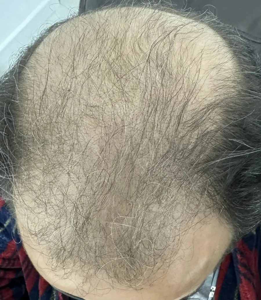 Top view of a scalp with fine, thinning hair