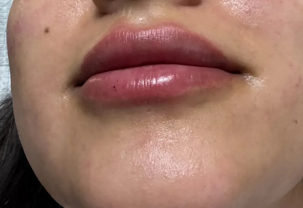 Close-up of the lips and chin showing fuller lips shortly after treatment