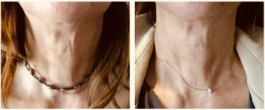 Side-by-side close-up photographs of a neck, before and after treatment