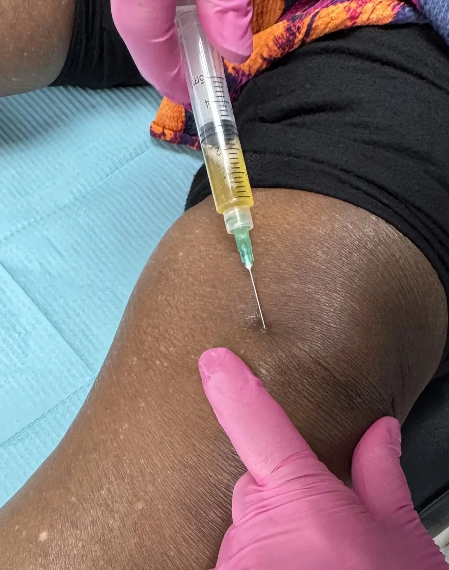 Gloved clinician injecting golden plasma from a syringe into a patient's knee while steadying the joint