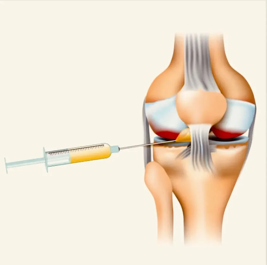 Illustration of a syringe of golden plasma injecting into the space of a knee joint