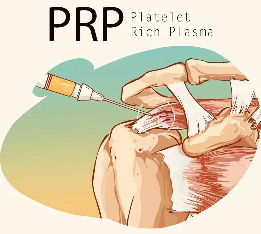 Illustration of PRP, platelet-rich plasma, being injected into a damaged tendon of the shoulder