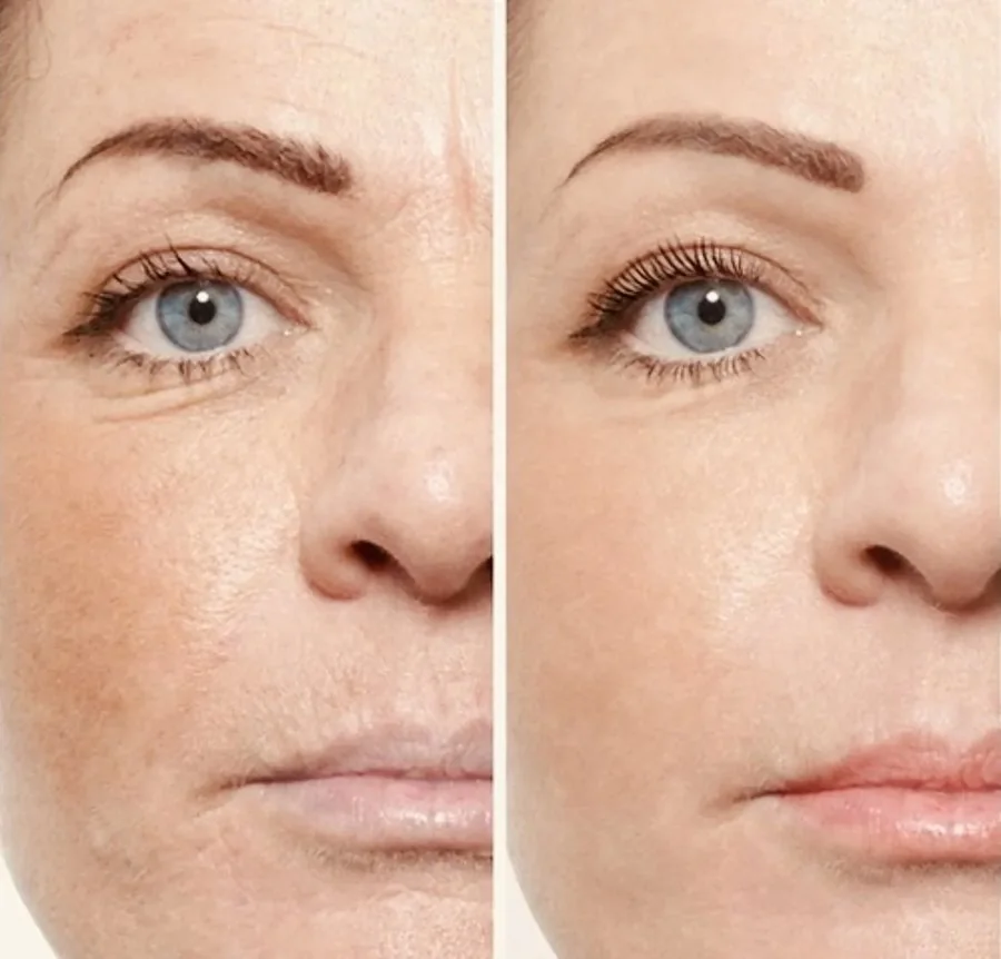 Side-by-side close-ups of one eye area and cheek, before and after treatment