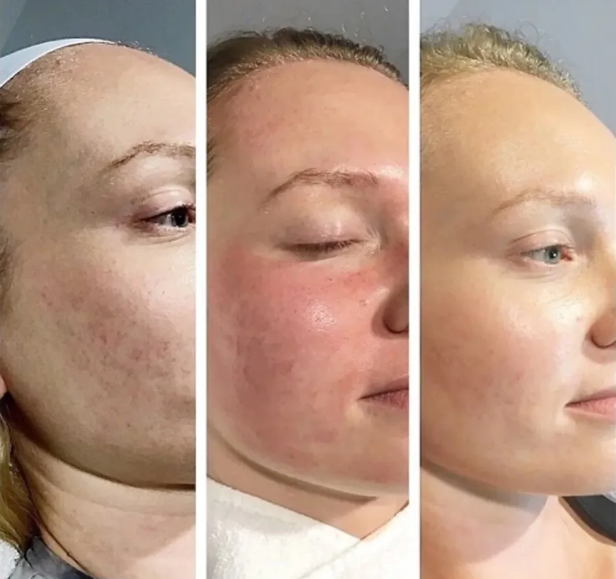 Three side views of a face showing skin at different stages of treatment