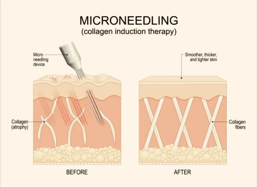 Diagram of microneedling, collagen induction therapy: a needling device creates micro-channels in the skin, and afterwards collagen fibres are denser and the skin smoother, thicker and tighter