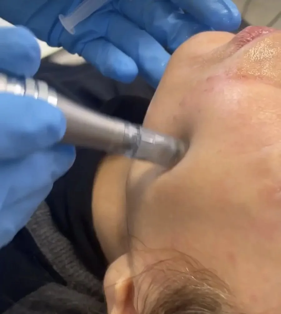 Microneedling pen being used on the cheek by a gloved clinician