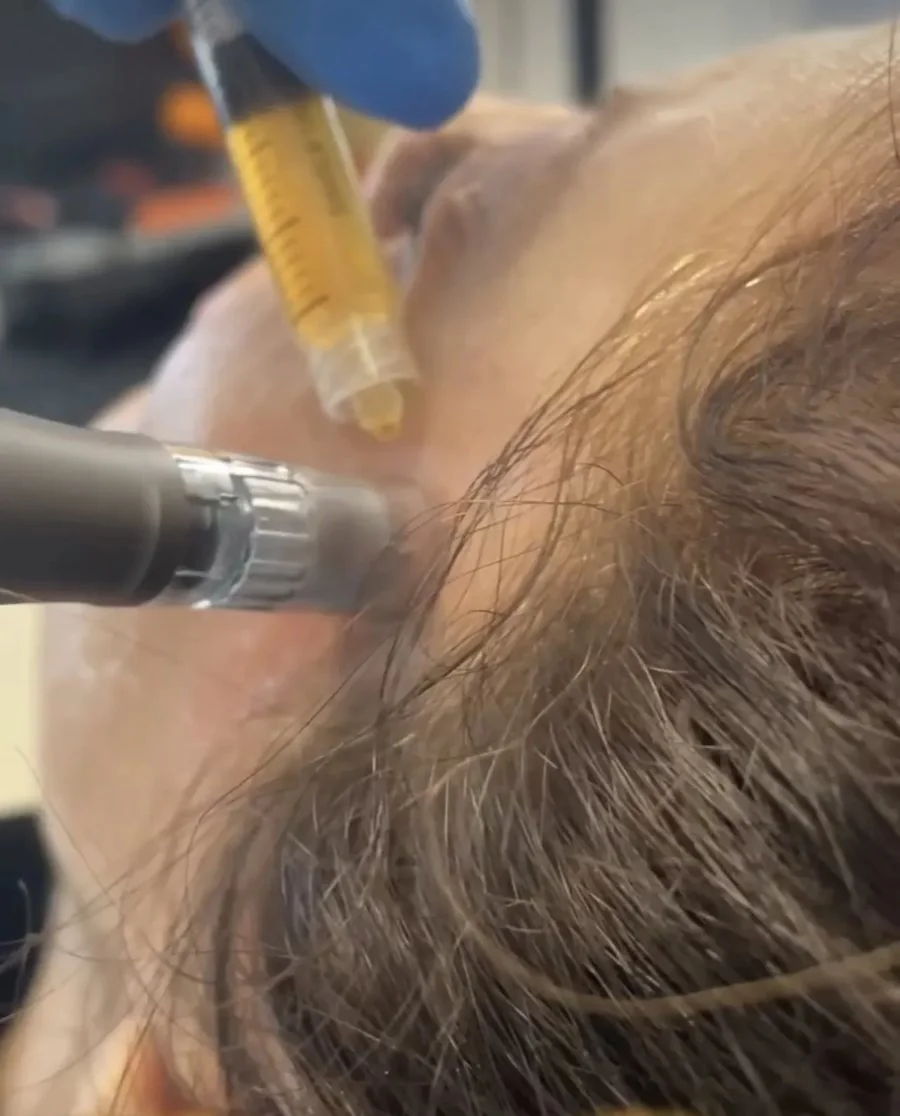 Microneedling pen treating the skin along the hairline while plasma from a syringe is applied
