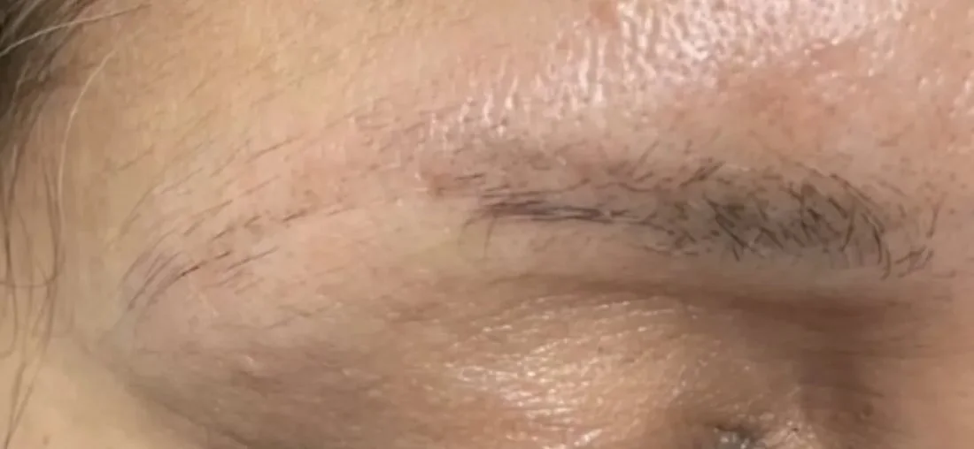 Close-up of a sparse eyebrow and surrounding skin