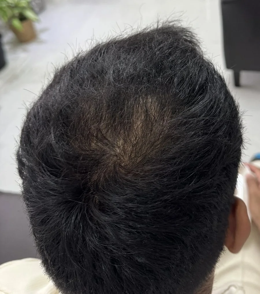 Back of the head showing thinning at the crown