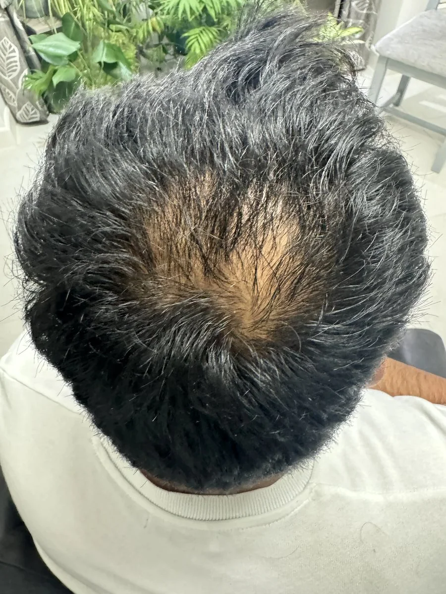 Top view of the head showing thinning at the crown