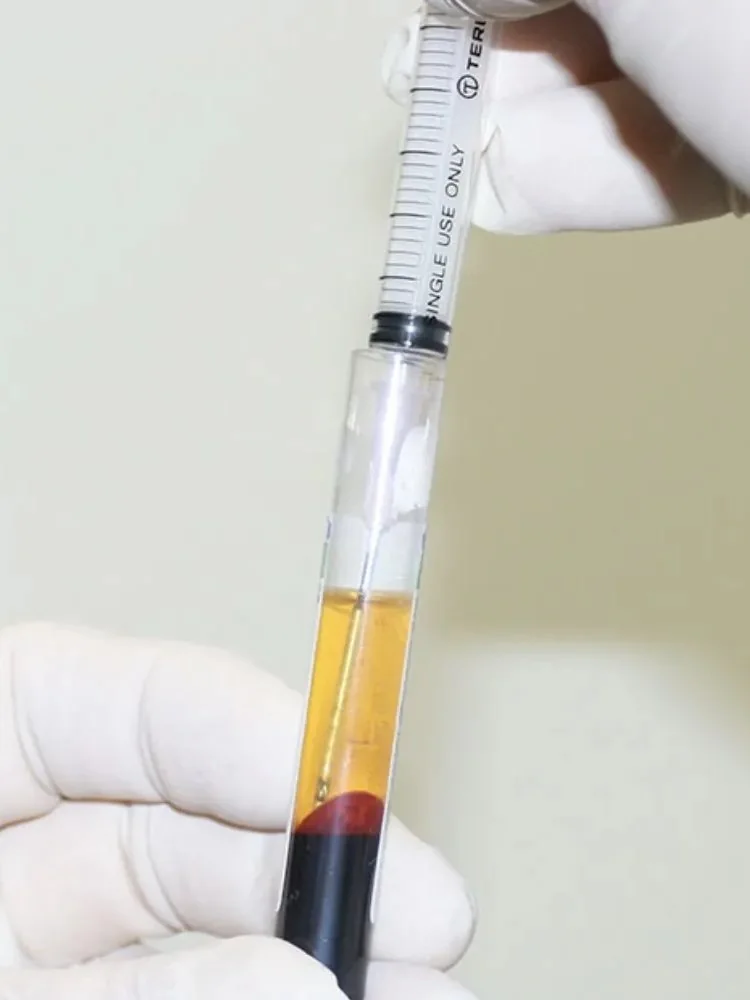 Gloved hands drawing platelet-rich plasma into a syringe from a tube of centrifuged blood, showing the golden plasma layer above the red blood cells