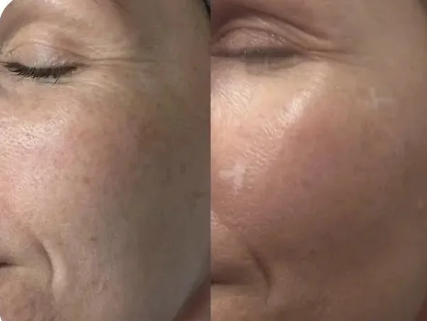 Side-by-side before and after comparison of the cheek